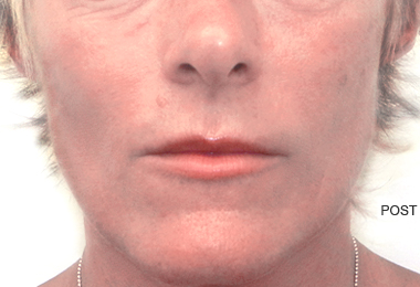 REGENYAL IDEA Bio-Expander